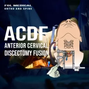 ACDF Anterior Cervical Discectomy and Fusion min